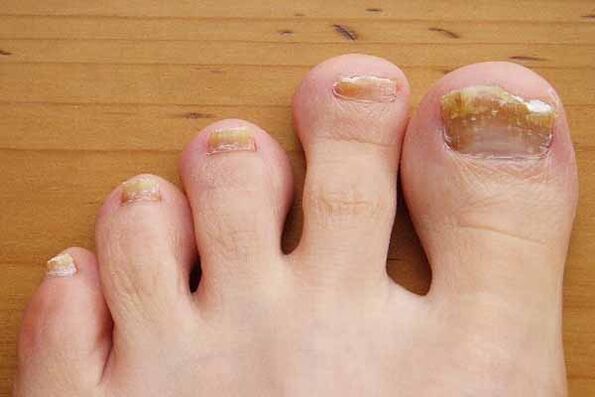 Appearance of toenails affected by fungus