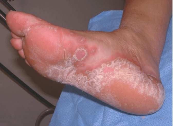 Define the fungus of the foot