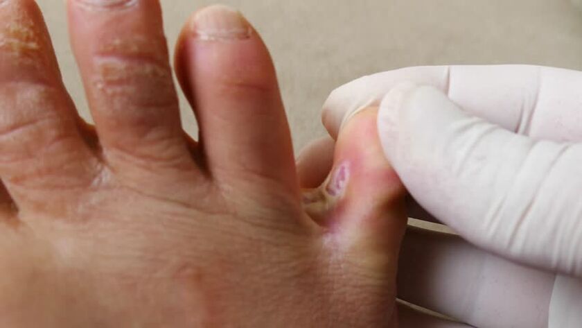 Fungi between fingers