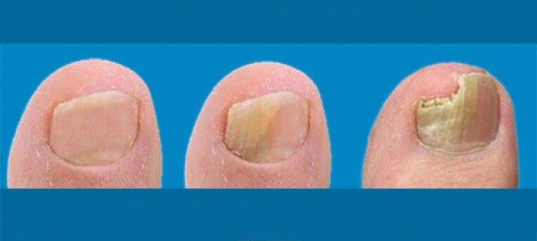 The process of developing nail fungus