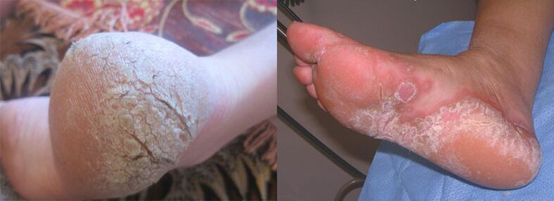 Legs affected by fungi