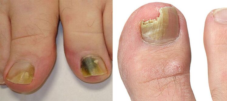 Onychomycosis - destruction of nails with a fungus