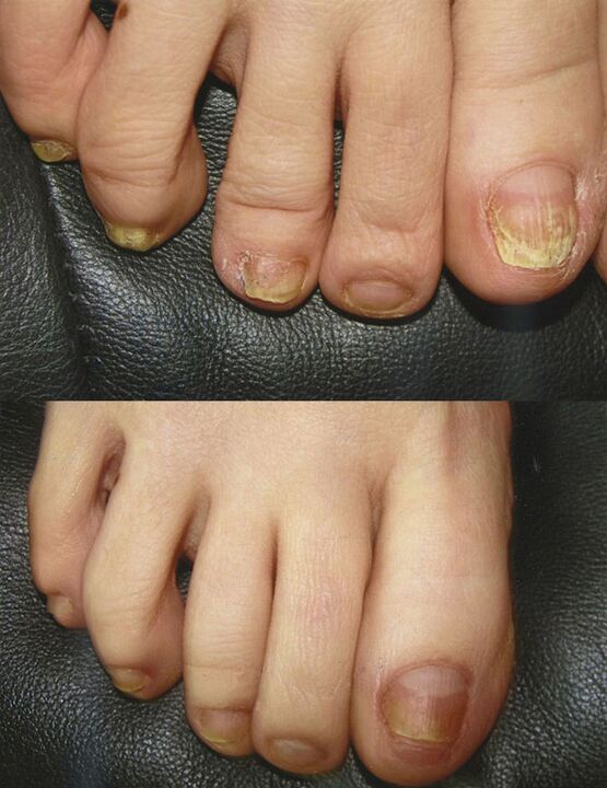Use of boric acid to treat fungi