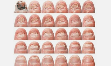 What looks like nail fungus