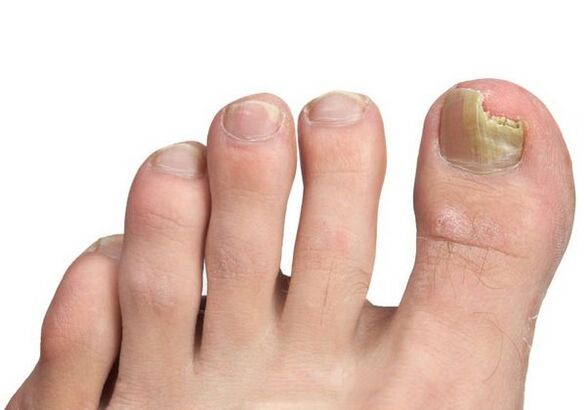 How is the infection with a fungus