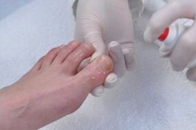 Treatment of fungal nails