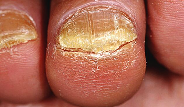 advanced toenail fungus