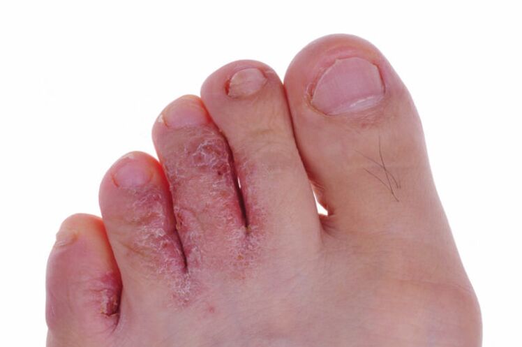 Red, cracked skin between the toes due to a fungal infection