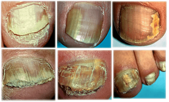 types and forms of toenail fungus