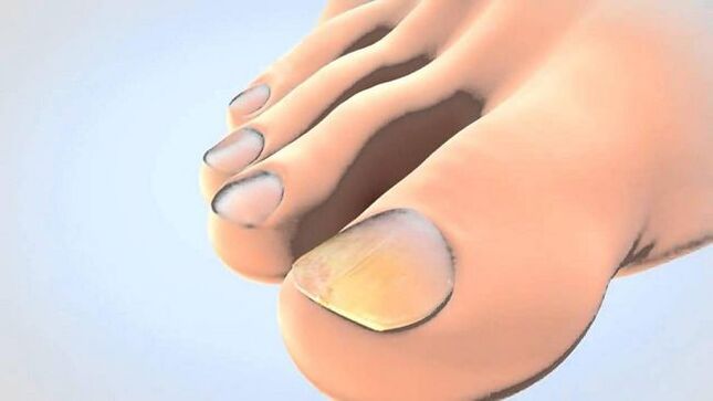 Fungal nails