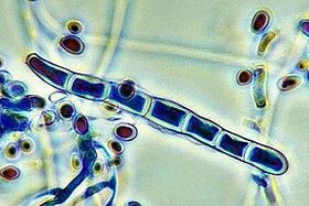 Pathogen of nail fungus under a microscope