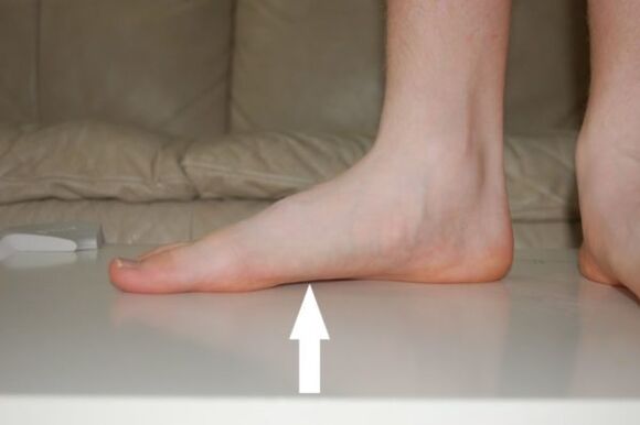 Flat feet are one of the causes of nail fungus