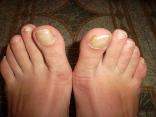 Fungal infection of the toenails