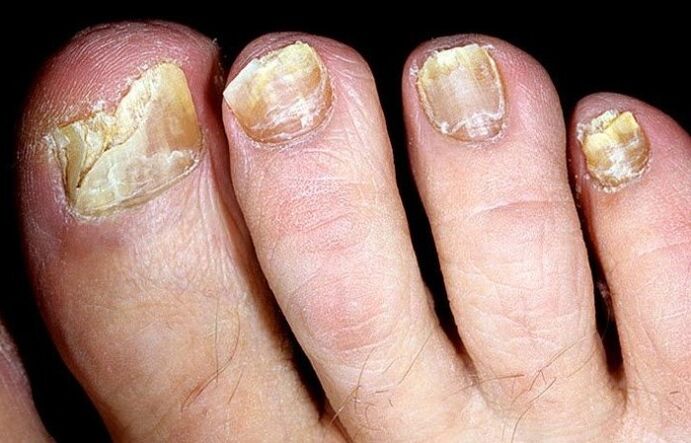 Advanced toenail fungus that requires complex treatment